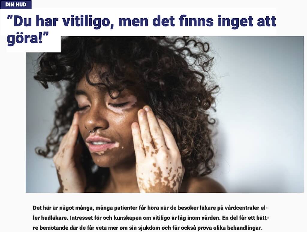 din-hud-teaser-vitiligo